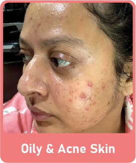 Oil and Acne Skin