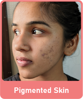 Pigmented Skin